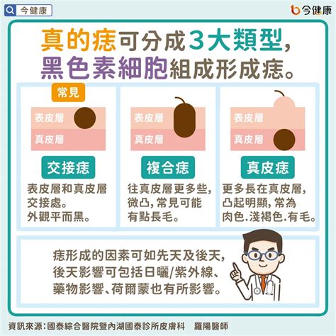 為什麼身上會有痣|是痣？皮膚癌？還是什麼？常見Q&A解惑！醫教揪出「。